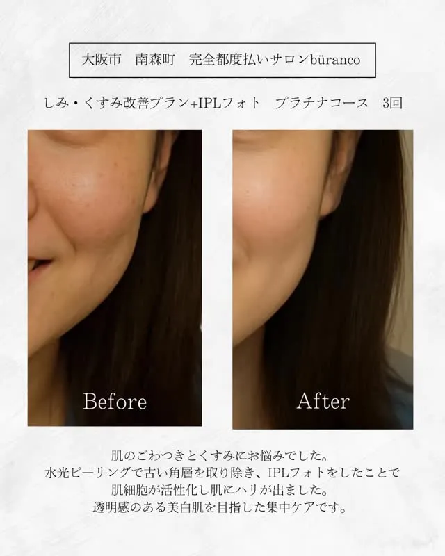 しみ・くすみでお悩みだったお客様。